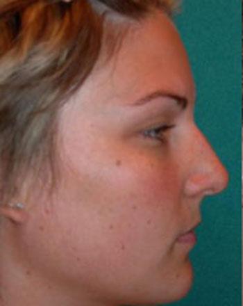 Before Results for Rhinoplasty